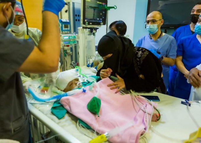 نجاح فصل التوأم السيامي اليمني “يوسف وياسين” في عملية استغرقت 15 ساعة 1 M9VdSKJ5