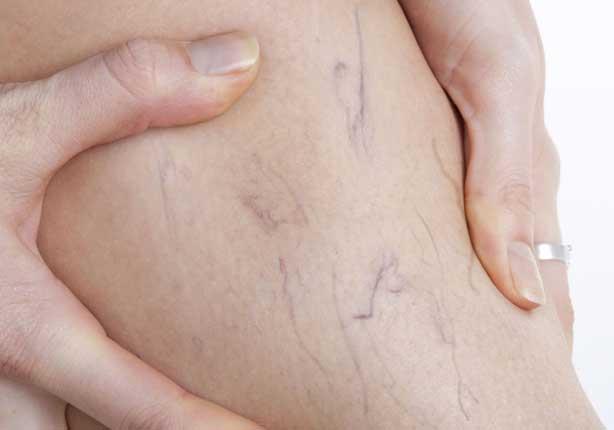 طبيبة روسية توضح كيف يمكن منع ظهور الدوالي